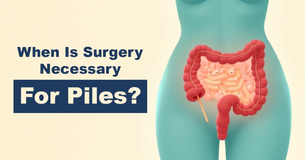 When Is Surgery Necessary for Piles?