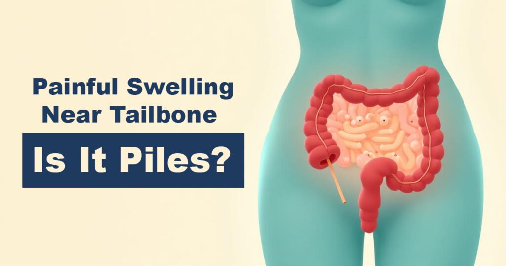 Painful Swelling Near Tailbone – Is It Piles?