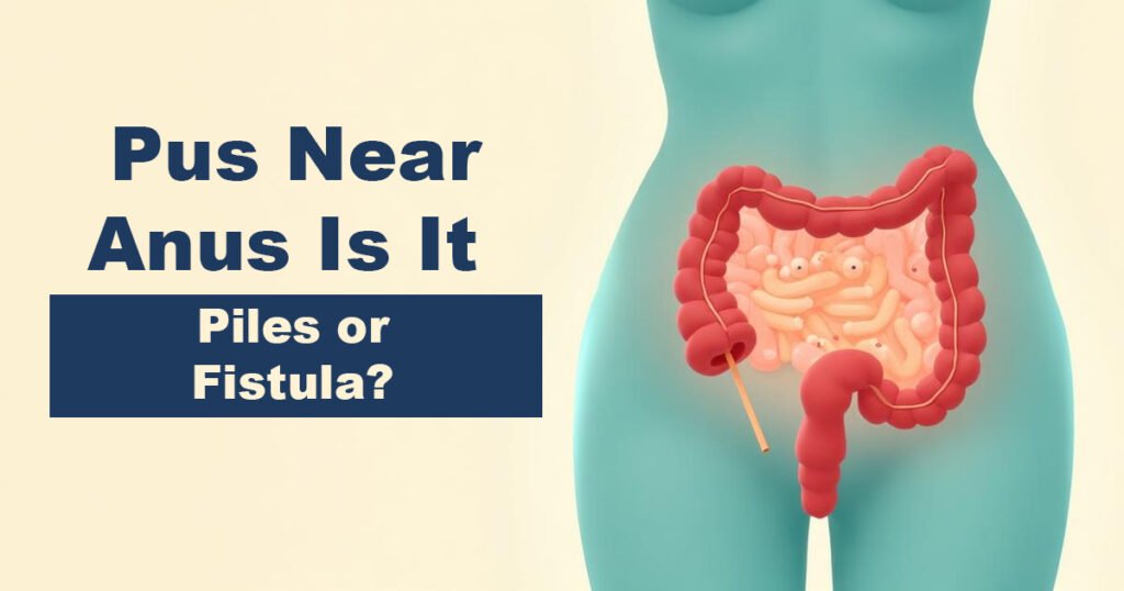 6-Pus-Near-Anus-–-Is-It-Piles-or-Fistula.jpg