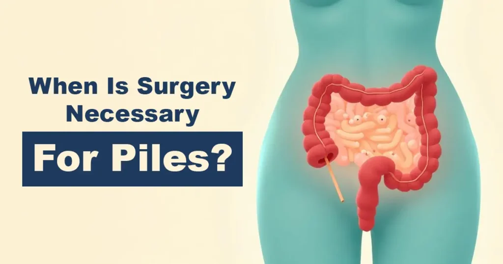 3 When Is Surgery Necessary for Piles - Karachi Piles Clinic piles surgery consultation guide