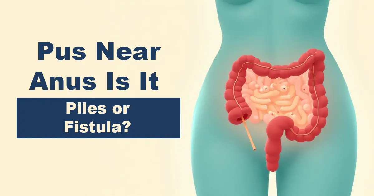 anal fistula specialist karachi pus discharge treatment