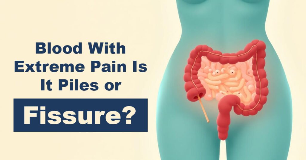Blood With Extreme Pain – Is It Piles or Fissure?