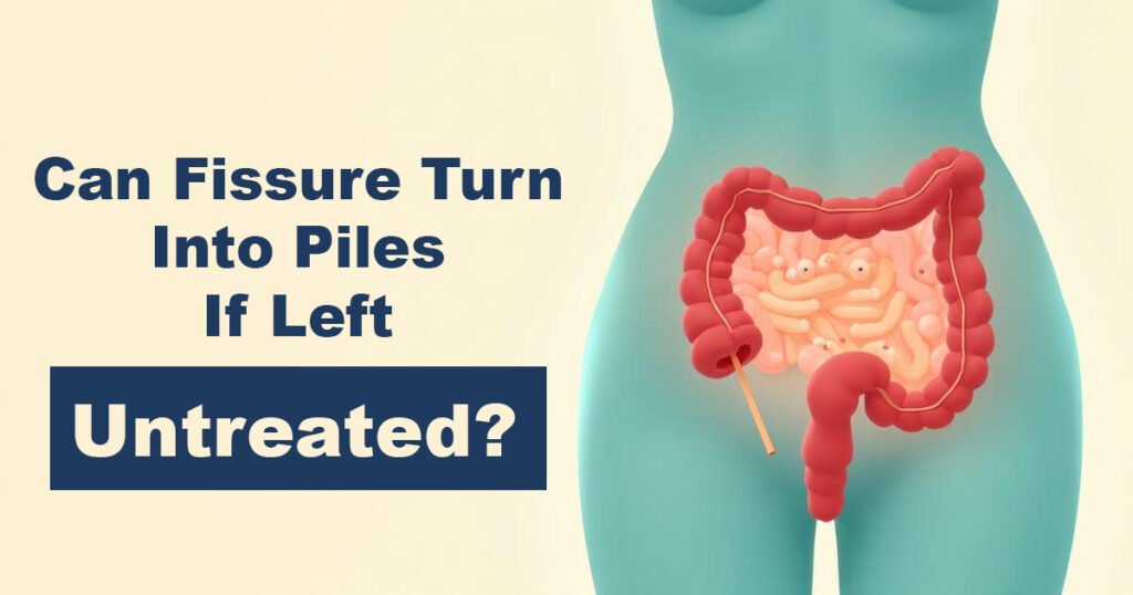 Can Fissure Turn Into Piles If Left Untreated?