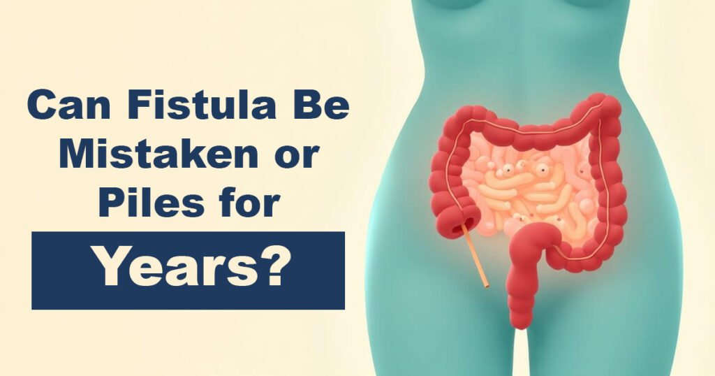 Can Fistula Be Mistaken for Piles for Years?