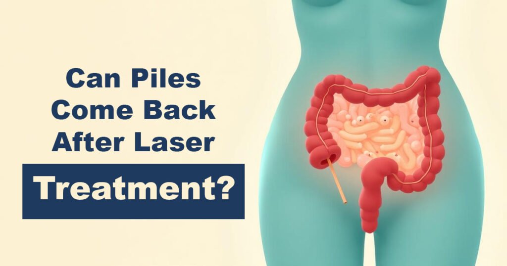 Can Piles Come Back After Laser Treatment?
