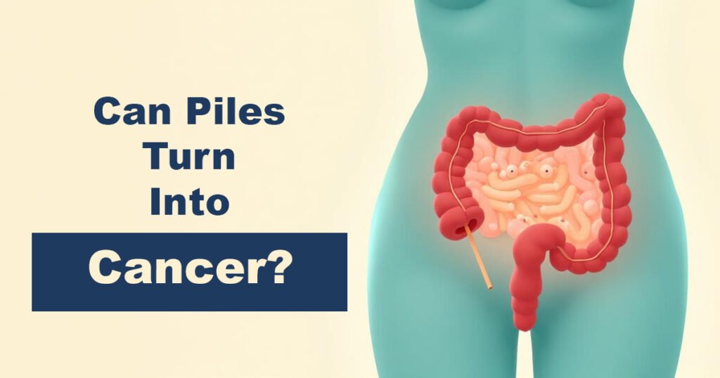 Can Piles Turn Into Cancer?