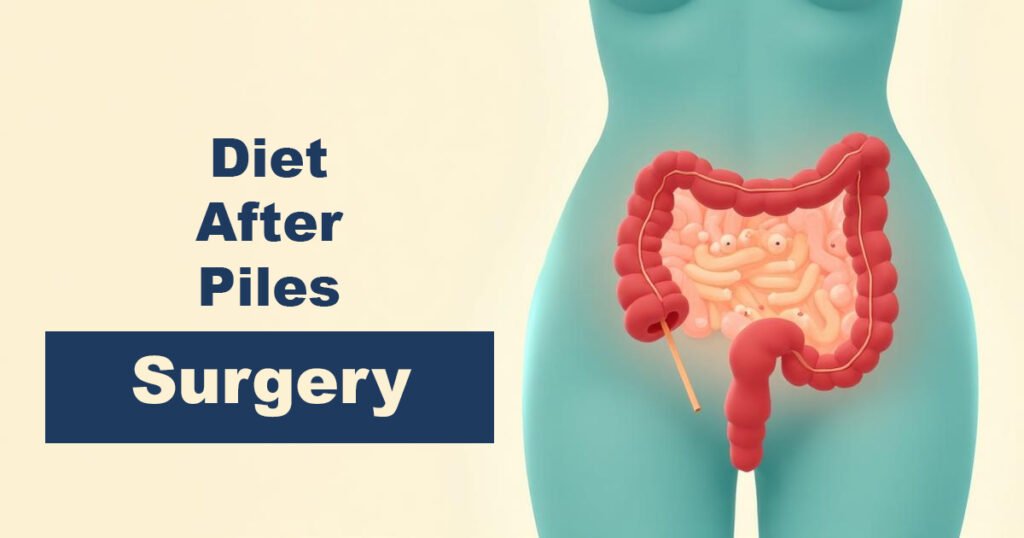 Diet After Piles Surgery