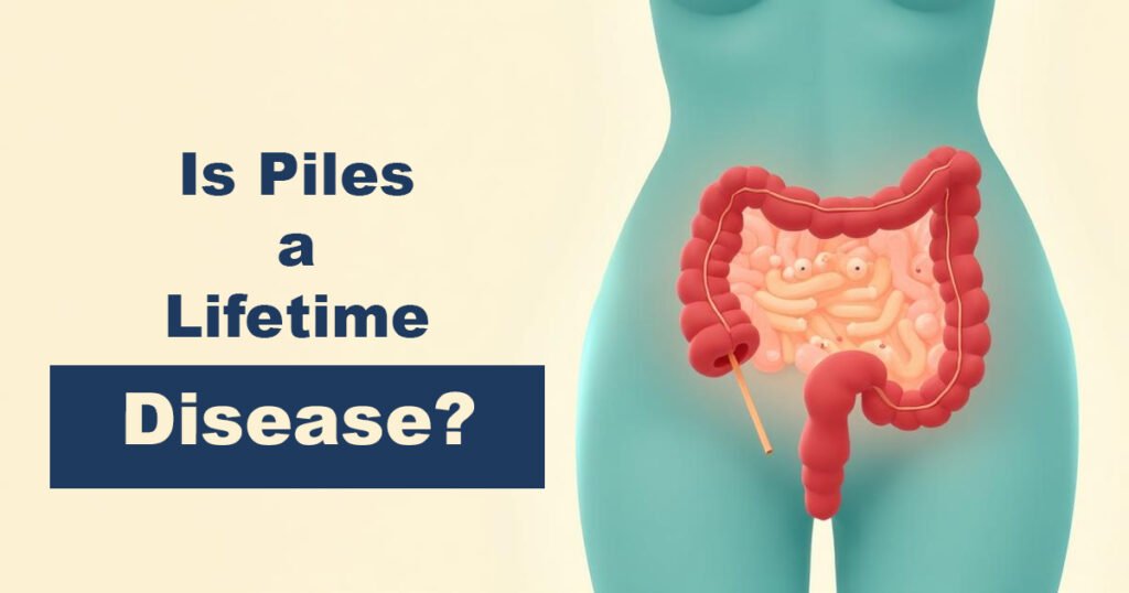 Is Piles a Lifetime Disease?
