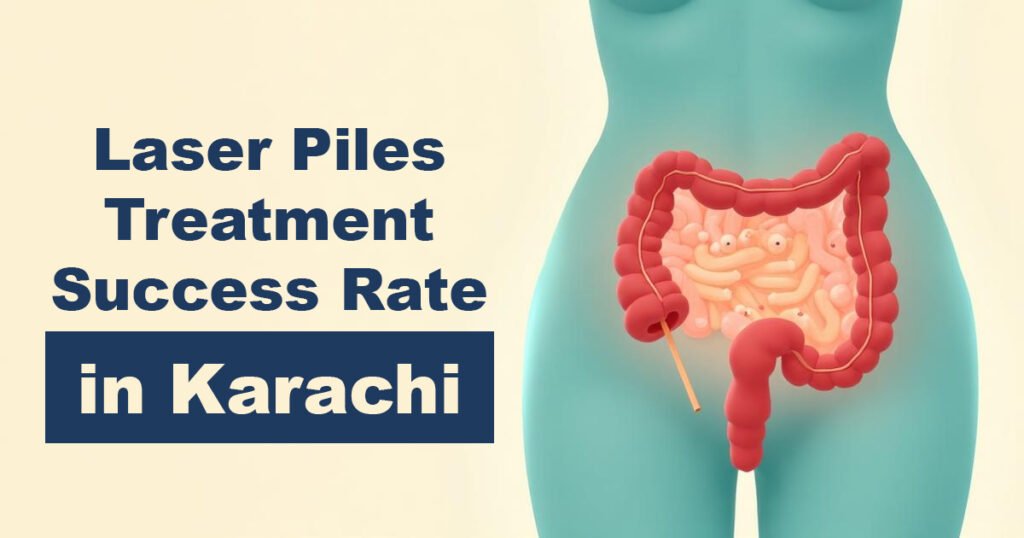 Laser Piles Treatment Success Rate in Karachi - Karachi Piles Clinic Laser Piles Treatment Success Rate in Karachi