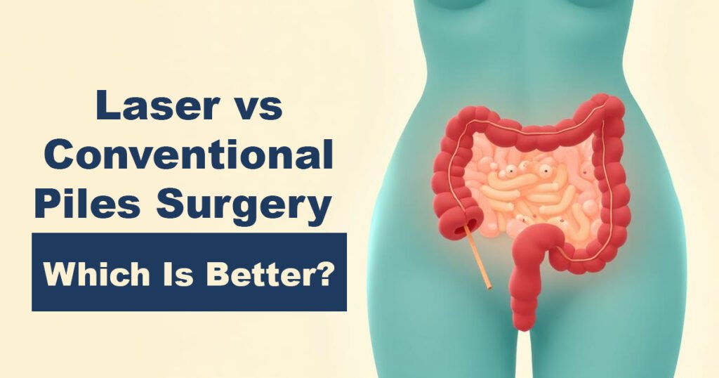 Laser vs Conventional Piles Surgery – Which Is Better?