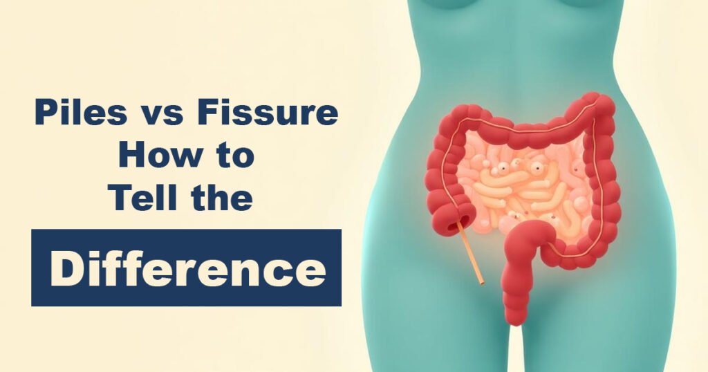 Piles vs Fissure How to Tell the Difference - Karachi Piles Clinic Piles vs Fissure – How to Tell the Difference