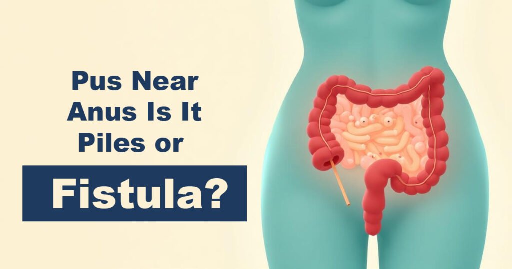 Pus Near Anus Is It Piles or Fistula - Karachi Piles Clinic Pus Near Anus – Is It Piles or Fistula?