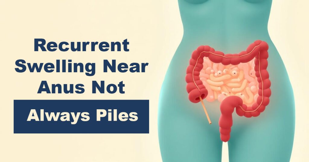 Recurrent Swelling Near Anus: Not Always Piles