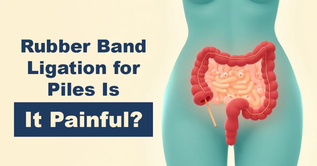 Rubber Band Ligation for Piles – Is It Painful?