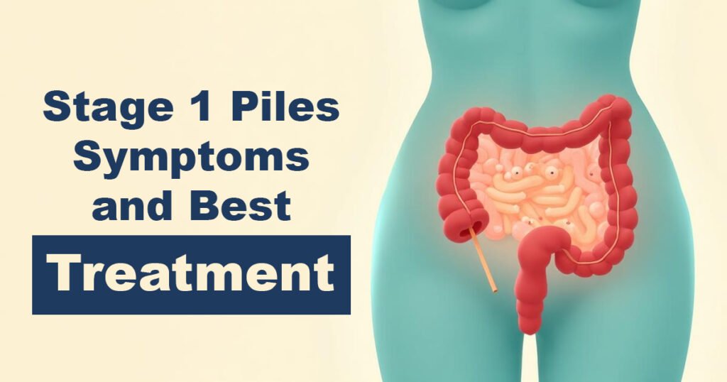 Stage 1 Piles – Symptoms and Best Treatment