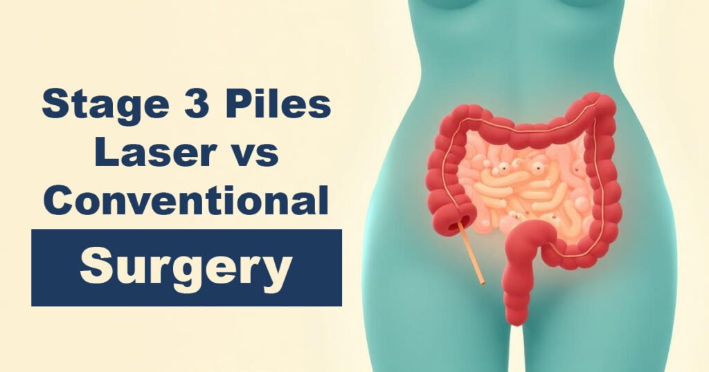 Stage 3 Piles – Laser vs Conventional Surgery