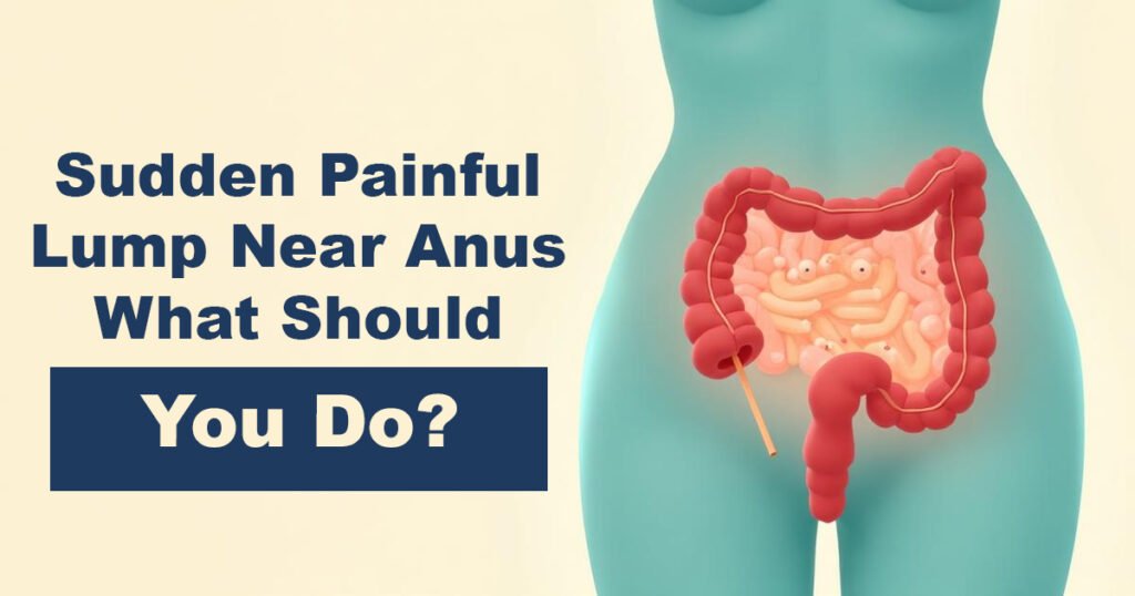 Sudden Painful Lump Near Anus – What Should You Do?