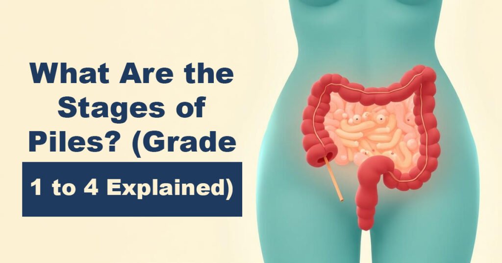 What Are the Stages of Piles? (Grade 1 to 4 Explained)