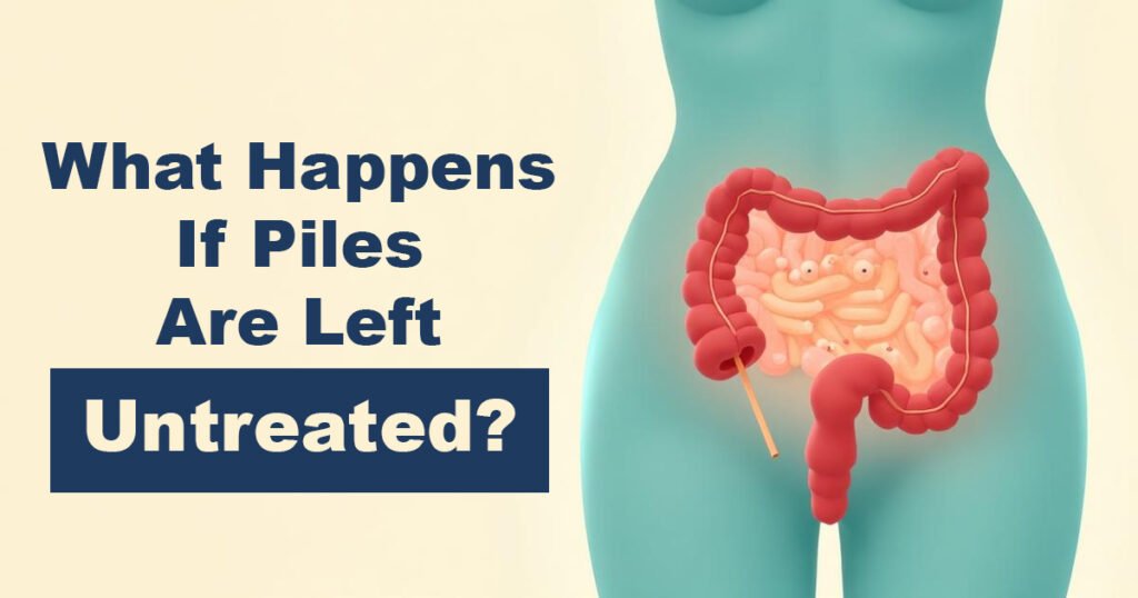 What Happens If Piles Are Left Untreated - Karachi Piles Clinic What Happens If Piles Are Left Untreated?