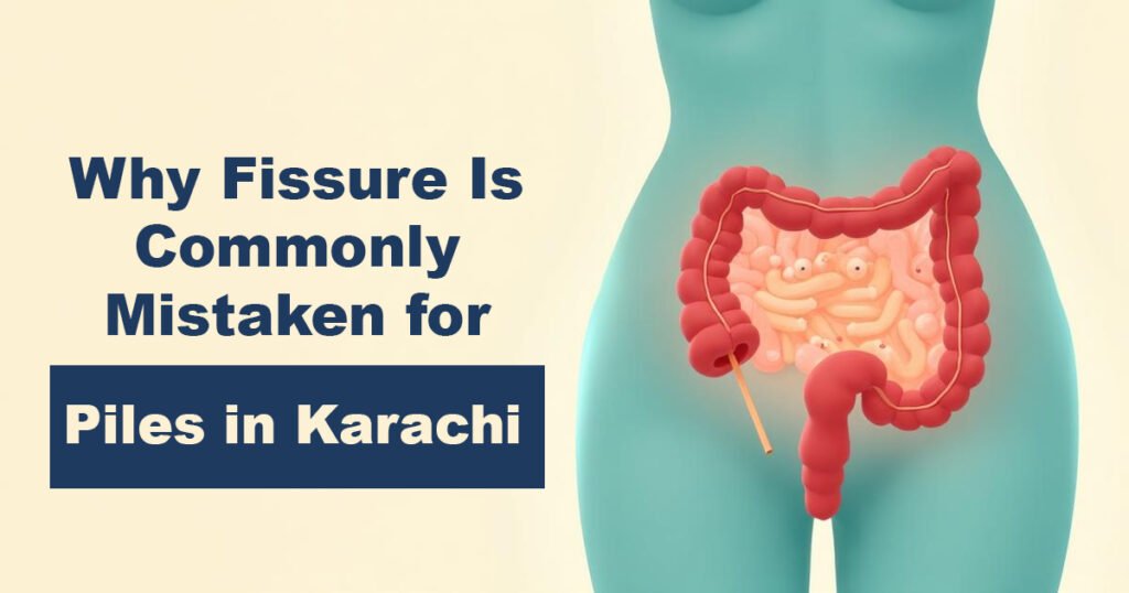 Why Fissure Is Commonly Mistaken for Piles in Karachi